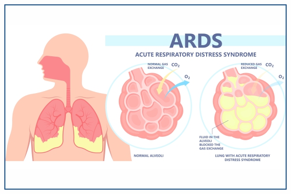 ards-full-form-symptoms-complications-and-causes